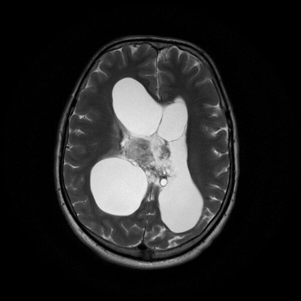 File:Central neurocytoma (Radiopaedia 67618-77021 Axial T2 16).jpg