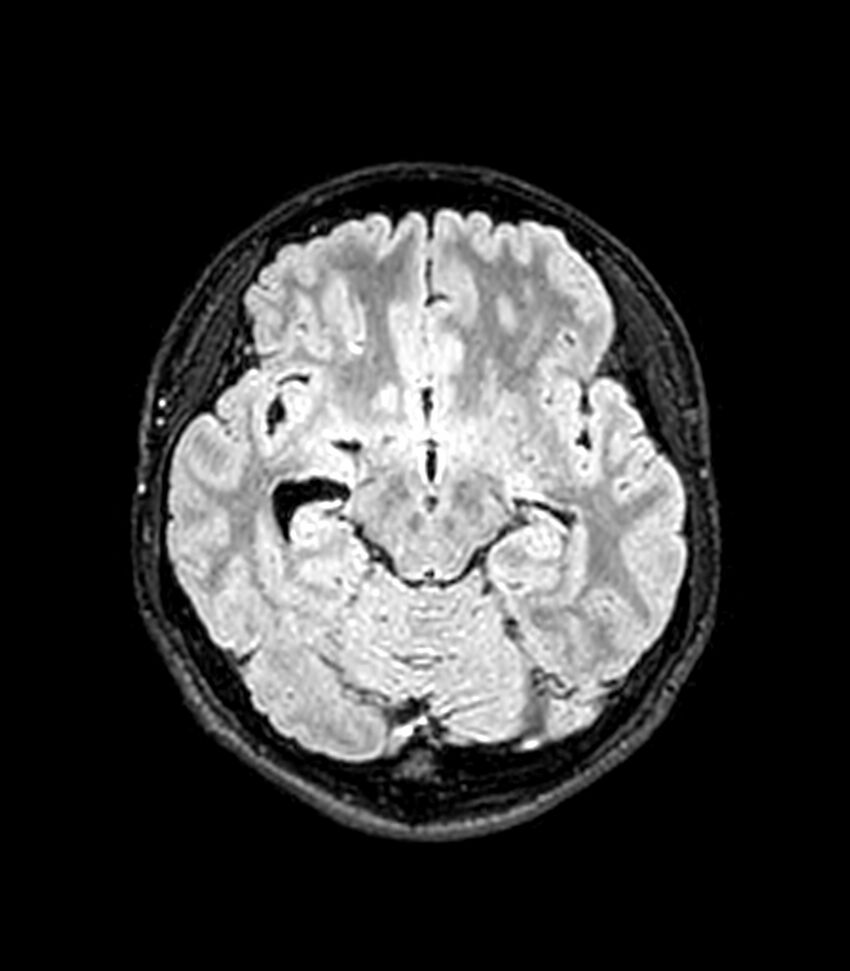 Central neurocytoma (Radiopaedia 79320-92380 Axial FLAIR 189).jpg