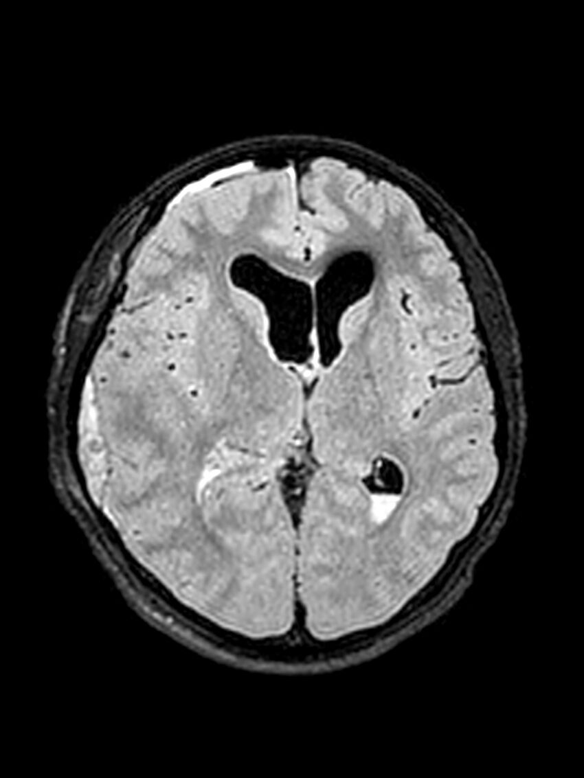 Central neurocytoma (Radiopaedia 79320-92381 Axial FLAIR 88).jpg