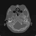 Cerebellar abscess secondary to mastoiditis (Radiopaedia 26284-26413 Axial bone window 35).jpg