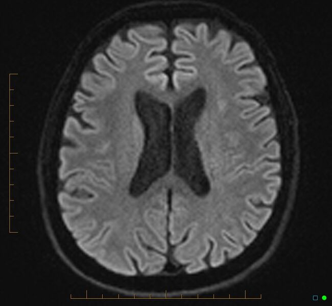 File:Cerebellar gangliocytoma (Radiopaedia 65377-74422 Axial DWI 24).jpg