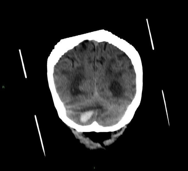 File:Cerebellar hemorrhage (Radiopaedia 58792-66026 Coronal non-contrast 18).jpg