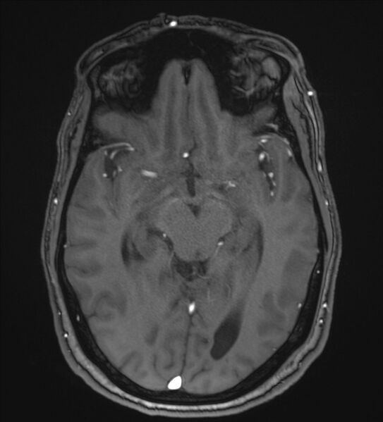 File:Cerebellopontine angle meningioma (Radiopaedia 72983-83680 Axial MRA 54).jpg
