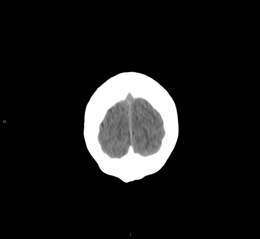 Cerebral amyloid angiopathy-associated lobar intracerebral hemorrhage (Radiopaedia 58530-65688 Coronal non-contrast 8).jpg
