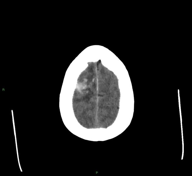 File:Cerebral amyloid angiopathy-associated lobar intracerebral hemorrhage (Radiopaedia 58560-65723 Axial non-contrast 9).jpg