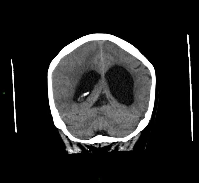 File:Cerebral amyloid angiopathy-associated lobar intracerebral hemorrhage (Radiopaedia 58560-65723 Coronal non-contrast 23).jpg