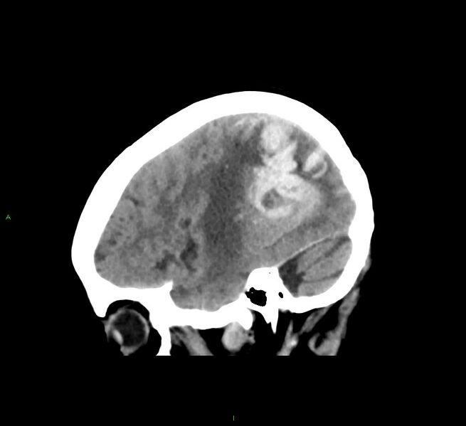 File:Cerebral amyloid angiopathy-associated lobar intracerebral hemorrhage (Radiopaedia 58563-65727 C 15).jpg