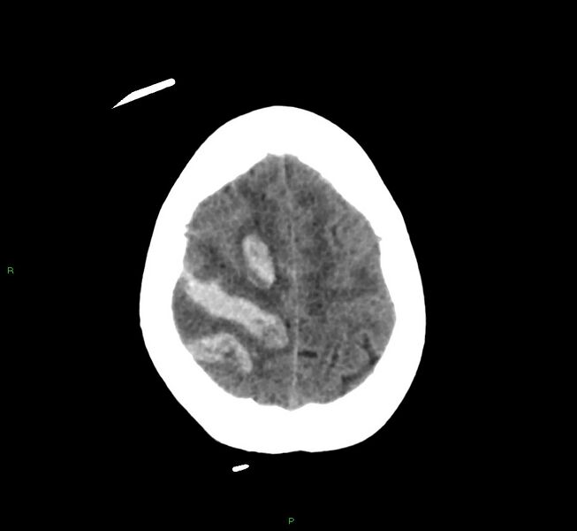 File:Cerebral amyloid angiopathy-associated lobar intracerebral hemorrhage (Radiopaedia 58566-65730 Axial non-contrast 10).jpg