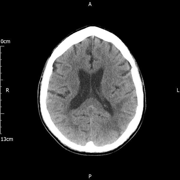 File:Cerebral amyloid angiopathy related inflammation (Radiopaedia 72772-83480 Axial non-contrast 16).jpg
