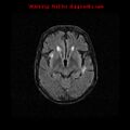 Cerebral and orbital tuberculomas (Radiopaedia 13308-13311 Axial FLAIR 10).jpg