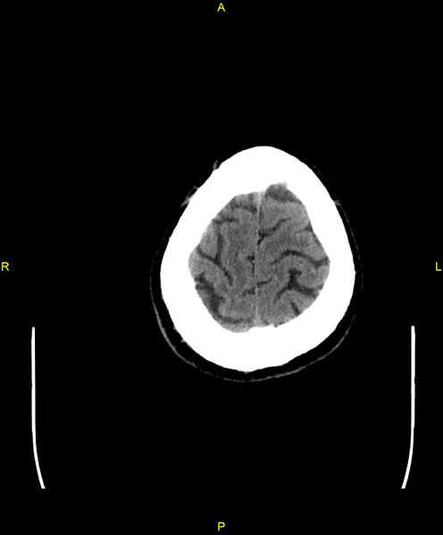 File:Cerebral autosomal dominant arteriopathy with subcortical infarcts and leukoencephalopathy (CADASIL) (Radiopaedia 86108-102051 Axial non-contrast 104).jpg