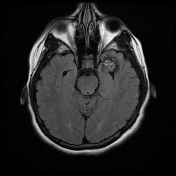 File:Cerebral cavernous malformation (Radiopaedia 44301-47942 Axial FLAIR 8).jpg