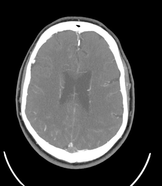 File:Cerebral dural venous sinus thrombosis (Radiopaedia 86514-102576 A 66).jpg