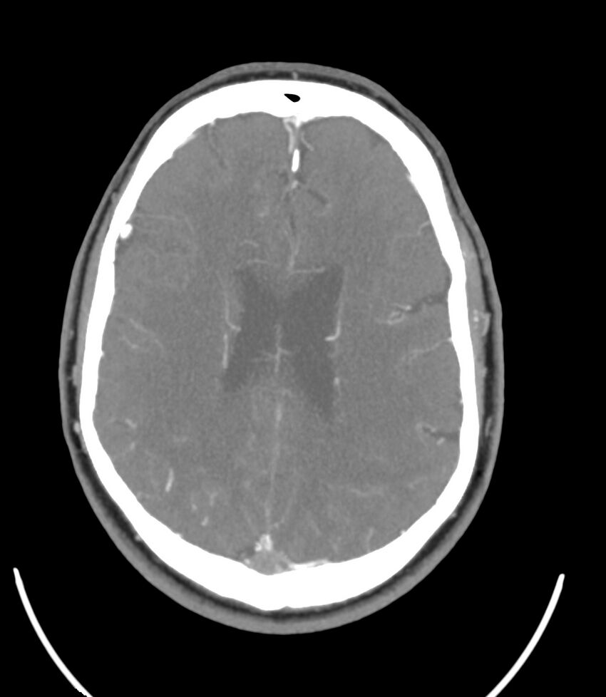 Cerebral dural venous sinus thrombosis (Radiopaedia 86514-102576 A 66).jpg