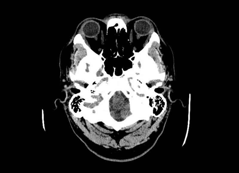 File:Cerebral edema (Radiopaedia 82519-96661 Axial non-contrast 47).jpg