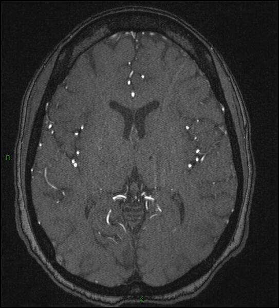 File:Cerebral fat embolism (Radiopaedia 35022-36525 Axial TOF 109).jpg