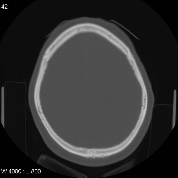 File:Cerebral hemorrhagic contusion with subdural and subarachnoid hemorrhage (Radiopaedia 10680-11146 Axial bone window 19).jpg