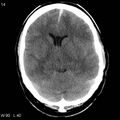 Cerebral hemorrhagic contusion with subdural and subarachnoid hemorrhage (Radiopaedia 10680-19197 Axial non-contrast 10).jpg