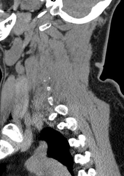 File:Cerebral hemorrhagic contusions and cervical spine fractures (Radiopaedia 32865-33841 G 36).jpg