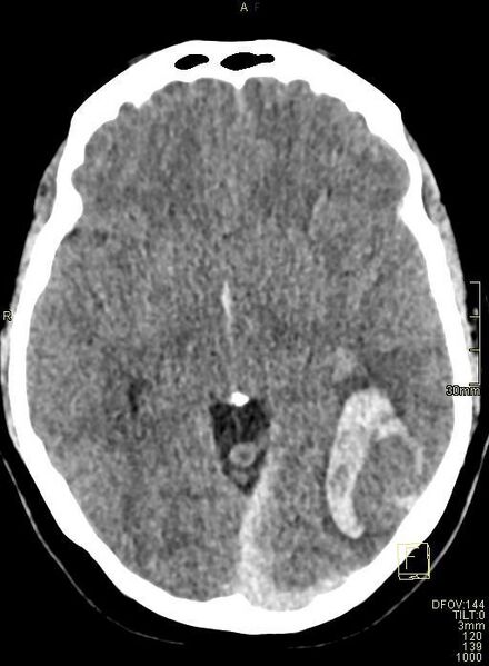 File:Cerebral venous sinus thrombosis (Radiopaedia 91329-108965 Axial non-contrast 23).jpg