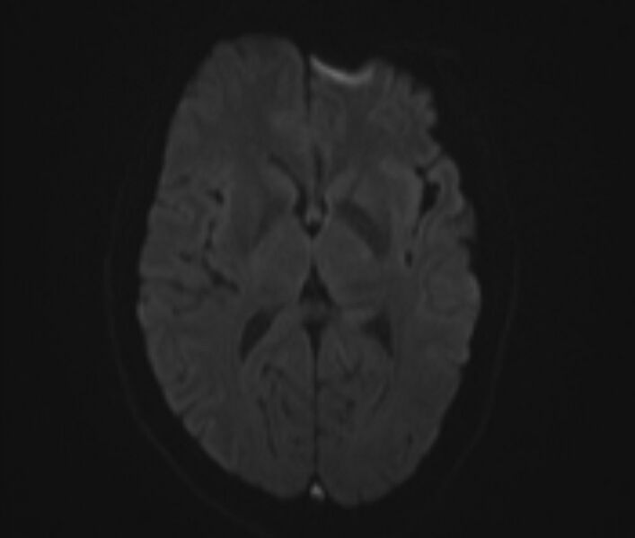 File:Cerebral venous thrombosis (Radiopaedia 71207-81504 Axial DWI 10).jpg