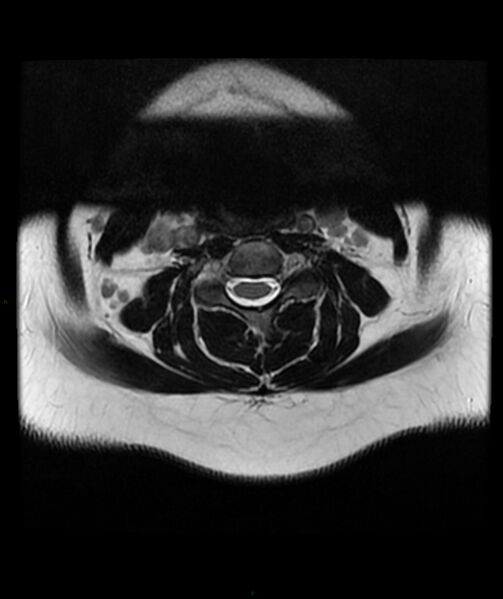 File:Cervical disc prolapse (Radiopaedia 80258-93598 Axial T2 20).jpg