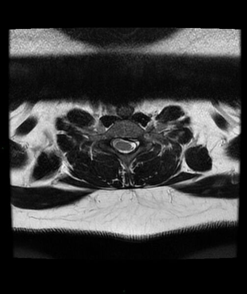 File:Cervical disc prolapse (Radiopaedia 80258-93598 Axial T2 64).jpg