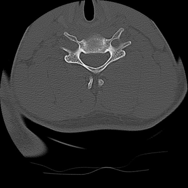 File:Cervical flexion teardrop fracture with cord hemorrhage (Radiopaedia 32497-33454 Axial bone window 57).jpg