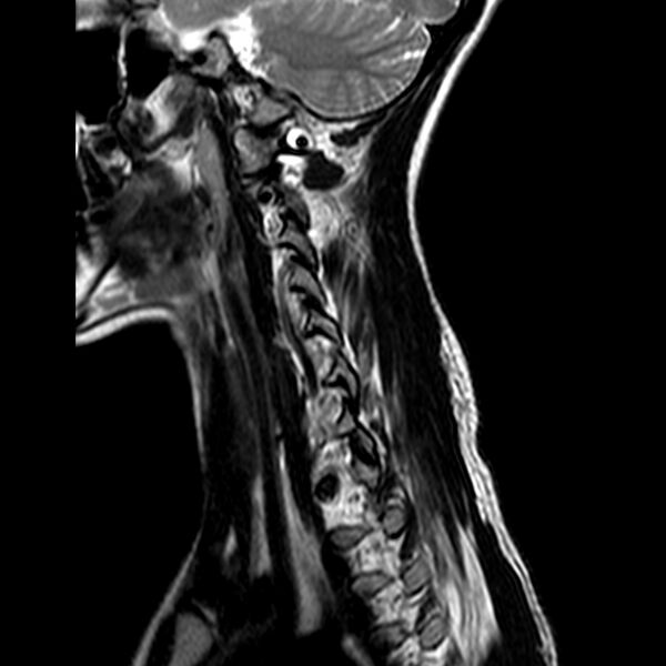 File:Cervical spine posterior ligamentous complex rupture (Radiopaedia 63486-72103 Sagittal T2 1).jpg