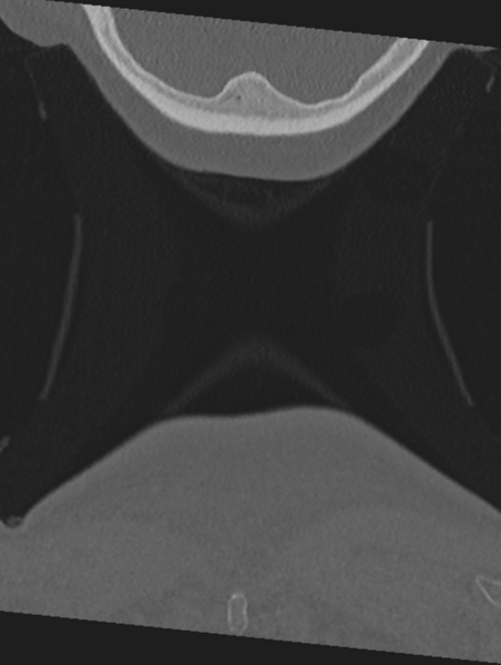 File:Cervical spondylolysis (Radiopaedia 49616-54811 Coronal bone window 76).png