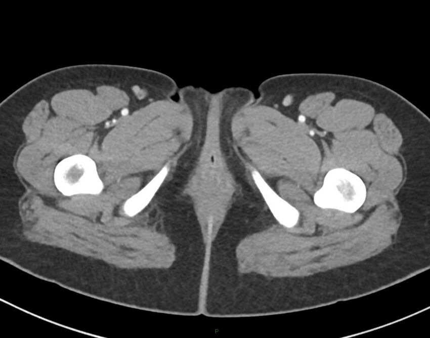 Cesarean scar endometriosis (Radiopaedia 82925-97262 A 95).jpg