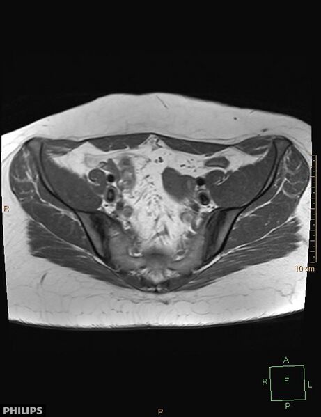 File:Cesarian scar endometriosis (Radiopaedia 68495-78066 Axial T1 6).jpg