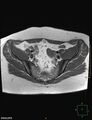 Cesarian scar endometriosis (Radiopaedia 68495-78066 Axial T1 6).jpg