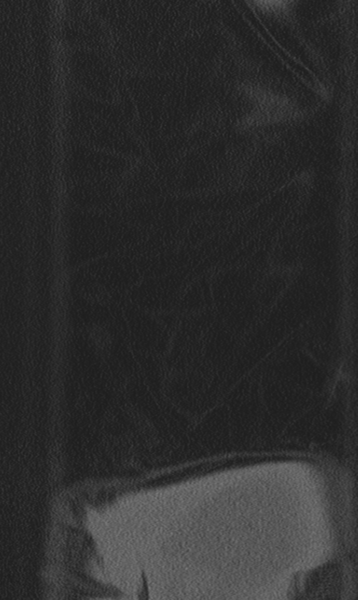 File:Chance fracture (Radiopaedia 40360-42912 Coronal bone window 81).png