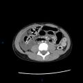 Chance fracture with duodenal and pancreatic lacerations (Radiopaedia 43477-46864 A 26).jpg