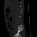 Chance fracture with duodenal and pancreatic lacerations (Radiopaedia 43477-50042 Sagittal bone window 1).jpg