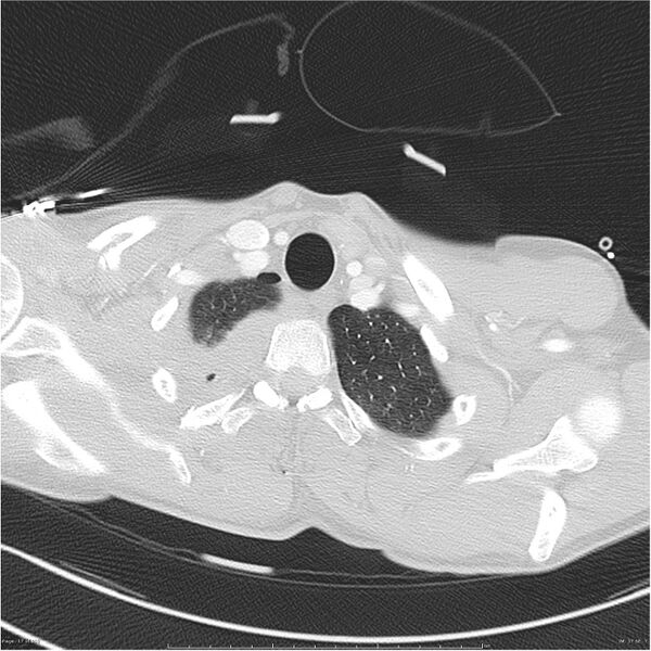 File:Chest and abdomen multi-trauma (Radiopaedia 26294-26425 lung window 17).jpg