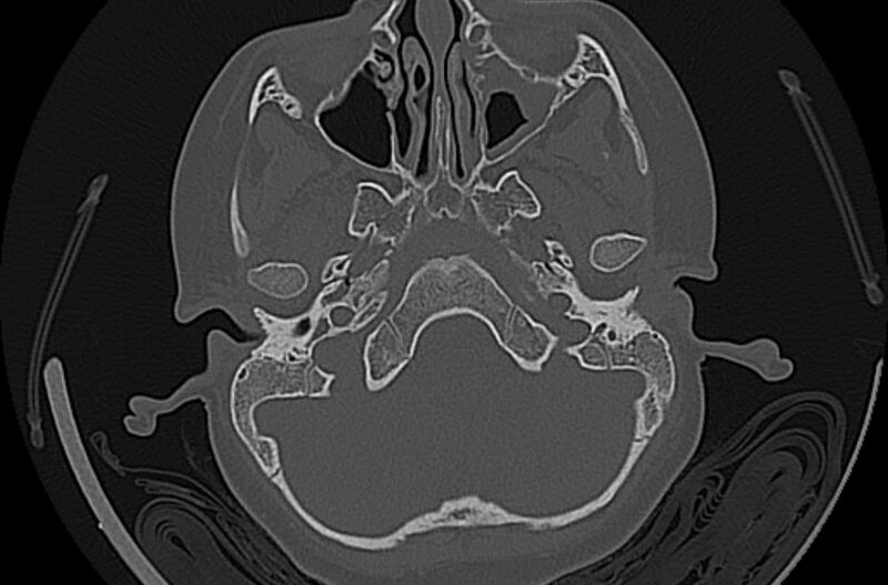 File:Cholesteatoma (Radiopaedia 73023-83750 Axial bone window 14).jpg