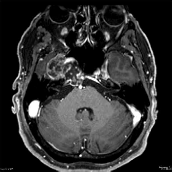 File:Chondrosarcoma of skull base- grade II (Radiopaedia 40948-43654 Axial T1 C+ 20).jpg
