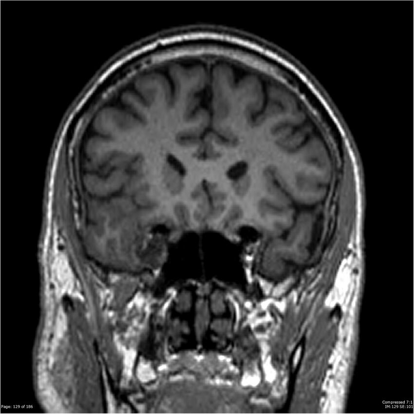 Chondrosarcoma of skull base- grade II (Radiopaedia 40948-43654 Coronal T1 50).jpg