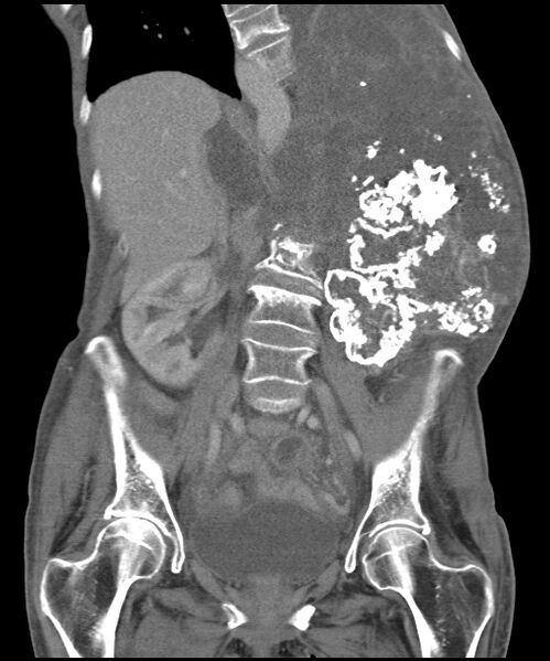 File:Chondrosarcoma of the spine (Radiopaedia 49871-55143 B 16).jpg