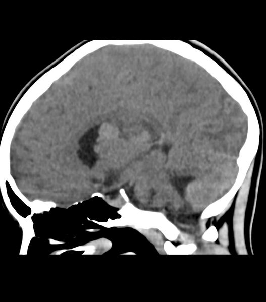 File:Choroid plexus carcinoma (Radiopaedia 91013-108552 B 34).jpg