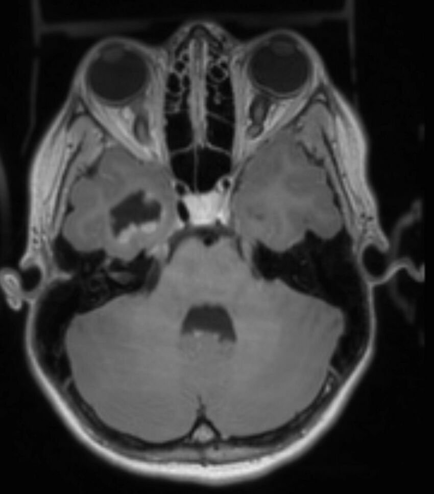 Choroid plexus carcinoma (Radiopaedia 91013-108553 Axial T1 C+ 100).jpg