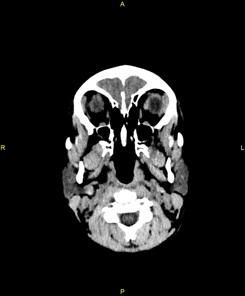 Choroidal fissure cyst (Radiopaedia 89481-106465 Axial non-contrast 11).jpg