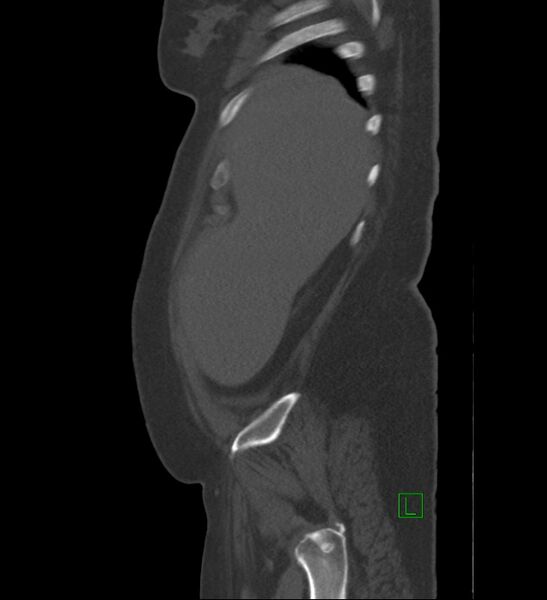 File:Chromophobe renal cell carcinoma (Radiopaedia 84239-99519 Sagittal bone window 94).jpg