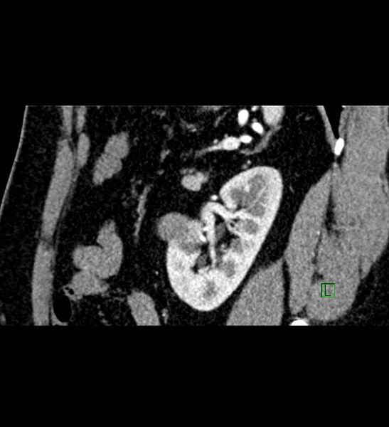 File:Chromophobe renal cell carcinoma (Radiopaedia 84286-99573 F 47).jpg