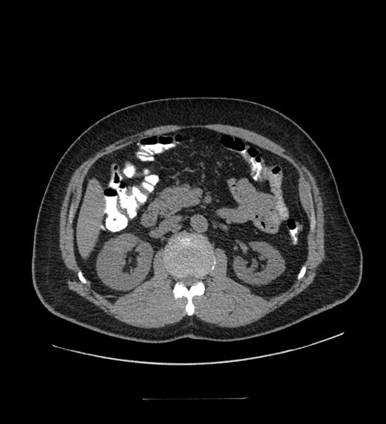 File:Chromophobe renal cell carcinoma (Radiopaedia 84337-99644 Axial non-contrast 40).jpg
