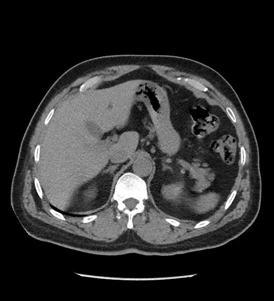 File:Chromophobe renal cell carcinoma (Radiopaedia 86879-103083 Axial non-contrast 15).jpg