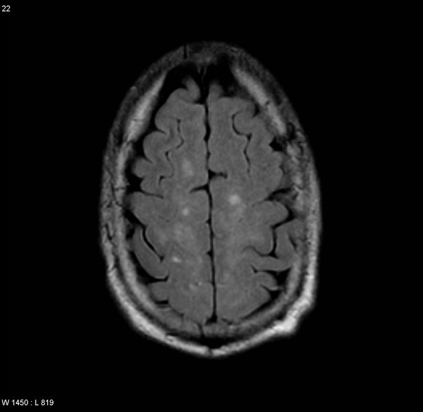File:Chronic hypertensive encephalopathy (Radiopaedia 4564-6686 Axial FLAIR 15).jpg