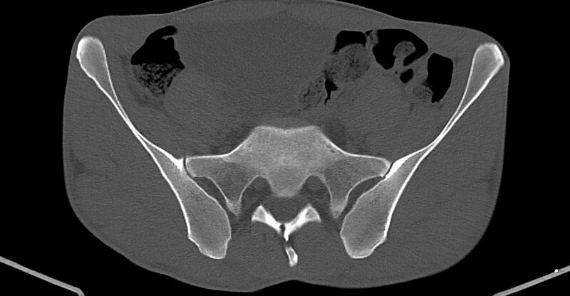 File:Chronic osteomyelitis (with sequestrum) (Radiopaedia 74813-85822 Axial non-contrast 5).jpg